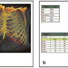 An enlarged or ruptured spleen can cause sudden or chronic pain under the left rib cage that ends up migrating towards the back and/or shoulders. Rib Cage Morphometric Differences Between A Normal 58 Year Old Male Download Scientific Diagram