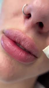 How to Remove Fordyce Spots under Eyes