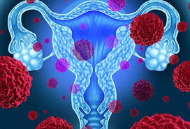 What Were Your First Signs Of Uterine Cancer