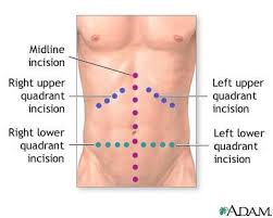 Ab Rehab After Injury Surgery Http Www Ehow Com Way 5214554 Abdominal Hernia Rehab Exercises Html Abdominal Surgery Surgery Abdominal Hernia