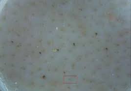 If a hair in an early stage of growth becomes trapped beneath the skin, or. Scielo Brasil Alopecia Universalis During Treatment With Leflunomide And Adalimumab Case Report Alopecia Universalis During Treatment With Leflunomide And Adalimumab Case Report