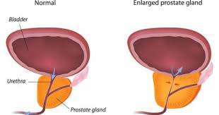 Check spelling or type a new query. Transurethral Resection Of The Prostate Turp Procedure