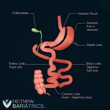 bariatric sleeve surgery digestive juice