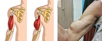 Image result for Biceps Tendon Injection