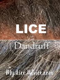 Image result for lice vs dandruff