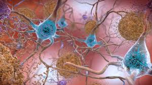 brain plaque alzheimer ile ilgili görsel sonucu