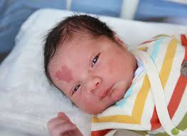Bebe Nacio Con Insolita Marca De Amor Nunca Antes Vista Marca De Nacimiento Bebe Cuidado Del Bebe