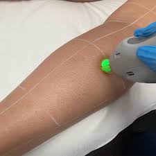 I have fairly thick hair covering my legs, all the way from my thighs to my feet. Laser Hair Removal Is Life Changing No More Painfully Shaving Waxing That Thick Coarse Hair And No More Exp Laser Hair Removal Hair Removal Thick Coarse Hair