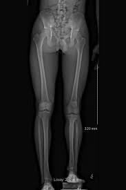 Image result for Functional Leg Length Discrepancy