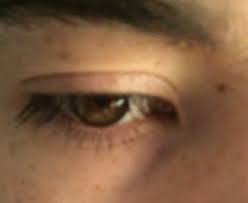 Epicanthic fold also called epicanthal fold fold of skin across the inner corner of the eye canthus. I M Caucasian And I Have Noticeable Epicanthal Folds What Are My Options To Fix Them Photos