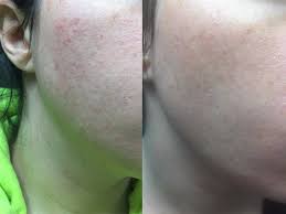 This past year, i treated the cysts with cortisone injections and had one excised. People Are Using Vaseline On Their Acne And It Actually Works