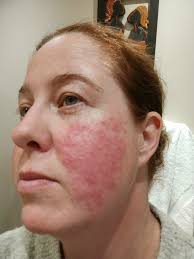 Hello, me again. My skin has very much cleared but i wake up with these red  pimple looking blemishes. They go down eventually. Plus I have a constant  mild redness, what one