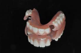 Depending on what teeth you are missing, partial dentures can be made for just the back or front teeth. Flexible Partials Art Dental Lab