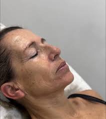 The New Carboxy Therapy Facial