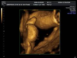 ultrassonografia ism