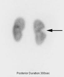 Image result for Renal Infarction