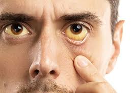 Cholestase Ursachen Symptome Behandlung Medlexi De