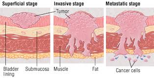 Bladder Cancer Harvard Health