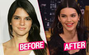 Kendall S Plastic Too Jenner S Cosmetic Transformation Exposed By Top Surg Kendall Jenner Plastic Surgery Celebrity Plastic Surgery Kardashian Plastic Surgery