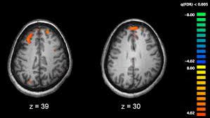 Schizophrenia is a chronic brain disorder that affects about one percent of the population. A New Look At How And When Schizophrenia Starts