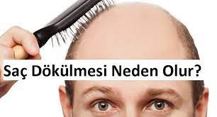Erkekler Ve Kadinlarda Sac Dokulmesi Alopesi Sac Dokulmesi Neden Olur Ufukta Bilgivar Sac Dokulmesi Sac Kadin