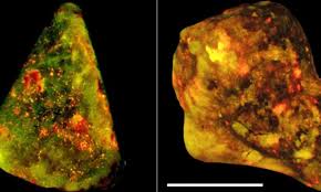 Thoughts, notes and general mental mayhem. Gallstone Sufferers May One Day Avoid Surgery Thanks To New Discovery Daily Mail Online