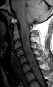 Krankheitsschübe wie auch läsionen in der magnetresonanztomographie (mrt) reflektieren den krankheitsprozess bei der… teriflunomid reduziert den jährlichen verlust an hirnvolumen frankfurt, 02. Http Cox Radiology Org Content E1653 E1541 E1919 E1931 E2082 Vorlesungspinalelaesioenwirbelsaeule Pdf