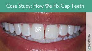 Treatment with braces for a teeth gap can be as quick as. What Is Diastema A Diastema Case Study From Southview Dentistry