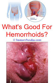 Pin On External Hemorrhoid Treatment