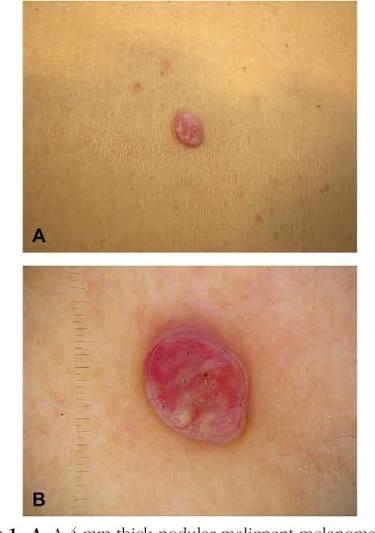 Pediatric melanoma: an opportunity for psychosocial research. | Semantic Scholar