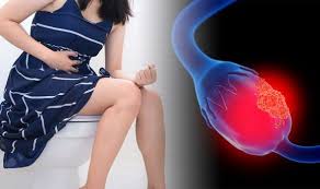 When this process begins, there may be no or only vague symptoms. Ovarian Cancer Symptoms This Sign When You Go To The Toilet May Signal The Deadly Disease Health Problems News