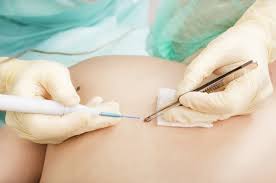 For more information and source,. Pilihan Cara Menghilangkan Tahi Lalat Alodokter
