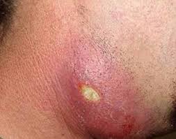 Rabach says another bad situation is that the hair causes an abscess (a huge bump filled with pus and inflammatory cells). Ingrown Hair Cyst Removal Won T Go Away Under Skin Groin Inner Thigh Armpit Treatment Pictures