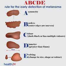 How to tell if a mole is cancerous. Can You Recognise The Signs Of Skin Cancer Health24