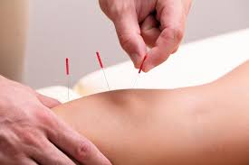 Suffering Arthritis Pain In Your Knee Acupuncture Can Deliver Relief Jersey Integrative Health And Wellness Sports Medicine Clinics