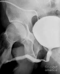 Image result for Voiding Cystourethrogram