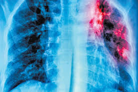 This term refers to not only girls but the male gender also. Tuberculosis Deadly Infectious But Curable Disease