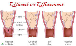 effaced or effacement how to measure cervical effacement