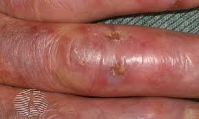Image result for Chilblains