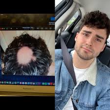 Hair loss treatment treating alopecia areata hair transplant what you can do. Happy Alopecia News Just Got My First Haircut In A Year Since Growing It Out To Cover My Alopecia My First Spot Appeared In February Of 2019 And Eventually Progressed To The