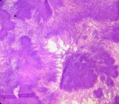 Mycetoma, also known as madura foot, is a neglected tropical disease that induces a diagnostic imaging is essential for confirmation of appropriate pathology and disease severity. Mycetoma Madura Foot A Case Report Musculoskeletal Key