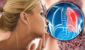 As the cancer develops, these symptoms may become more severe or intense. Lung Cancer Symptoms Signs Include Yellow Skin And Eyes Jaundice Express Co Uk