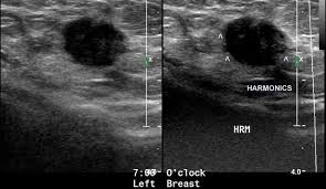Breast cancer is the most common cancer found in women, but most breast lumps are not cancer. A Gallery Of High Resolution Ultrasound Color Doppler 3d Images Breast