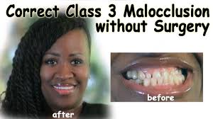 Correct Class 3 Malocclusion Without Surgery Dental Implants Cost Dental Implant Surgery Dentist