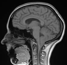 Maybe you would like to learn more about one of these? Http Fr Ap Hm Fr Sites Default Files Files Malformation 20de 20chiari Pdf