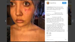 Nashville country star Meghan Linsey shares horrifying spider bite photos |  WZTV