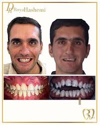 شمام اين سوالو از دکترتون زياد ميپرسين؟😂😅 پس تا اخر ببينين تا به جوابتون  برسين😂 #fun #smil #dentisty #braces #uae #ارتودنسی_زیبایی #ارتودنسي_تخصصي  #ارتودنسي #فان #شوخي #خنده #اينستاگرام