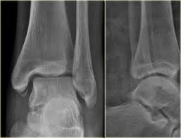 Traditionally this avulsion fracture has been ascribed to the insertion of peroneus brevis and is caused by forcible inversion of the foot in plantar flexion, as may occur while stepping on a curb or climbing steps. The Radiology Assistant Weber And Lauge Hansen Classification