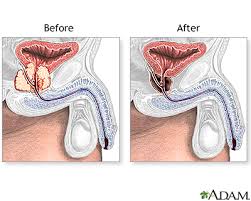 Although the percentage of cases in men is much lower than in women, male breast cancer accounts for a por. Prostatectomy Series Aftercare Medlineplus Medical Encyclopedia