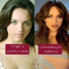 Sabe aquele famoso que ficou "mais bonito" e você nem sabe explicar o  porquê? É uma harmonização facial bem feita! ✨ Sim, muitos dos rostos que  você admira passaram por técnicas que